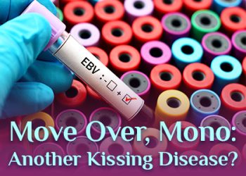 Salt Lake City dentist, Dr. Brickey at Natural Smiles Dentistry, talks about a kissing disease you might be less familiar with than mononucleosis.