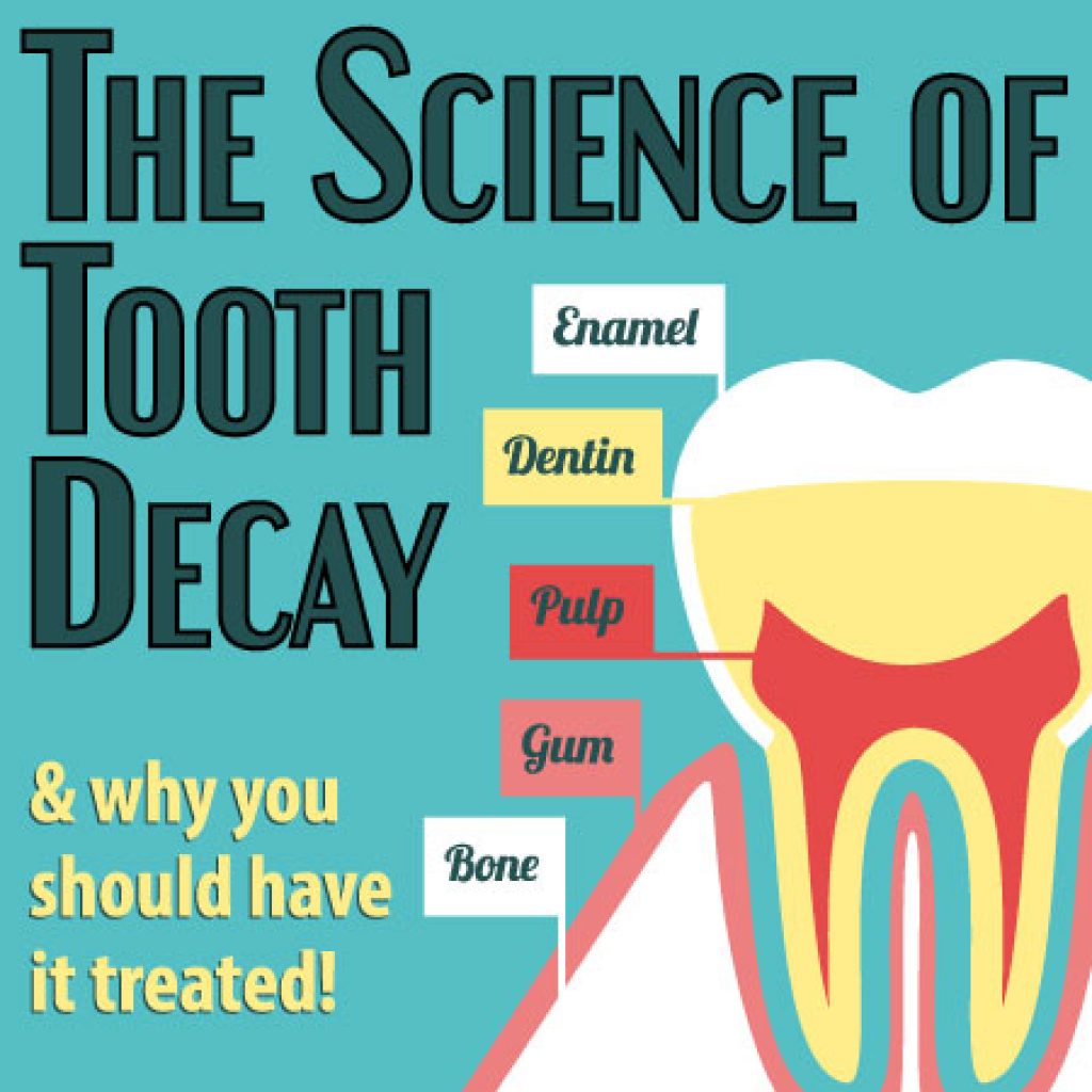 tooth-decay-in-salt-lake-city-dr-brickey