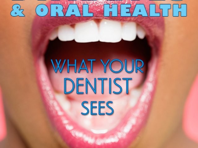 Diabetes and Oral Health: What Your Dentist Sees (featured image)